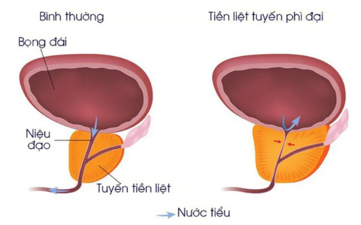 phi dai tuyen tien liet 1712231888279 1712231889244351555069