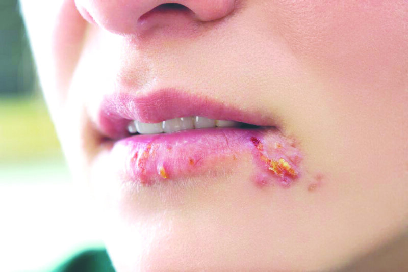 Tìm hiểu Bệnh Herpes miệng - Nỗi ám ảnh đeo bám cuộc sống 5 20210310 Herpes moi 1