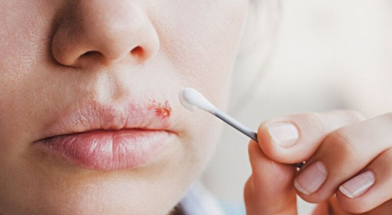 Tìm hiểu Bệnh Herpes miệng - Nỗi ám ảnh đeo bám cuộc sống 7 20210310 Herpes moi 2