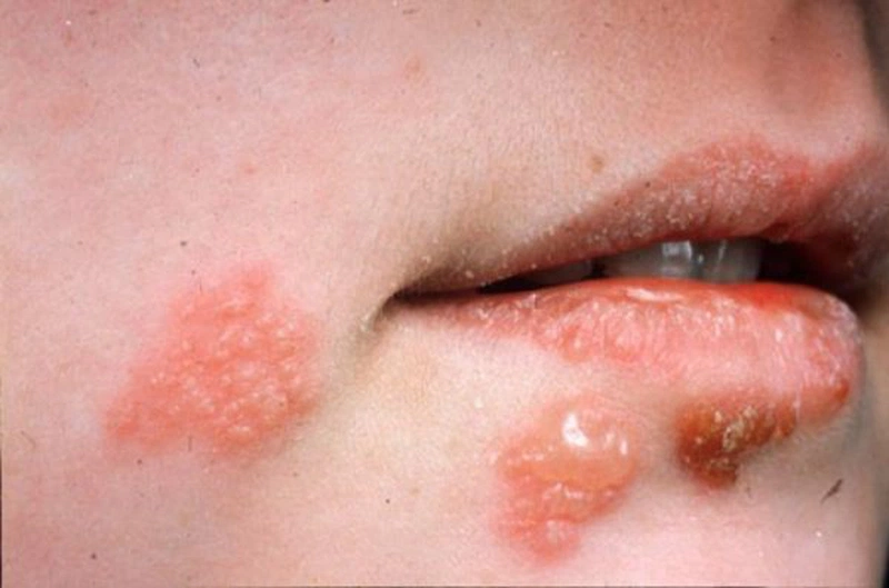 Benh herpes moi khong de doa den tinh mang nhung co nhieu bien chung