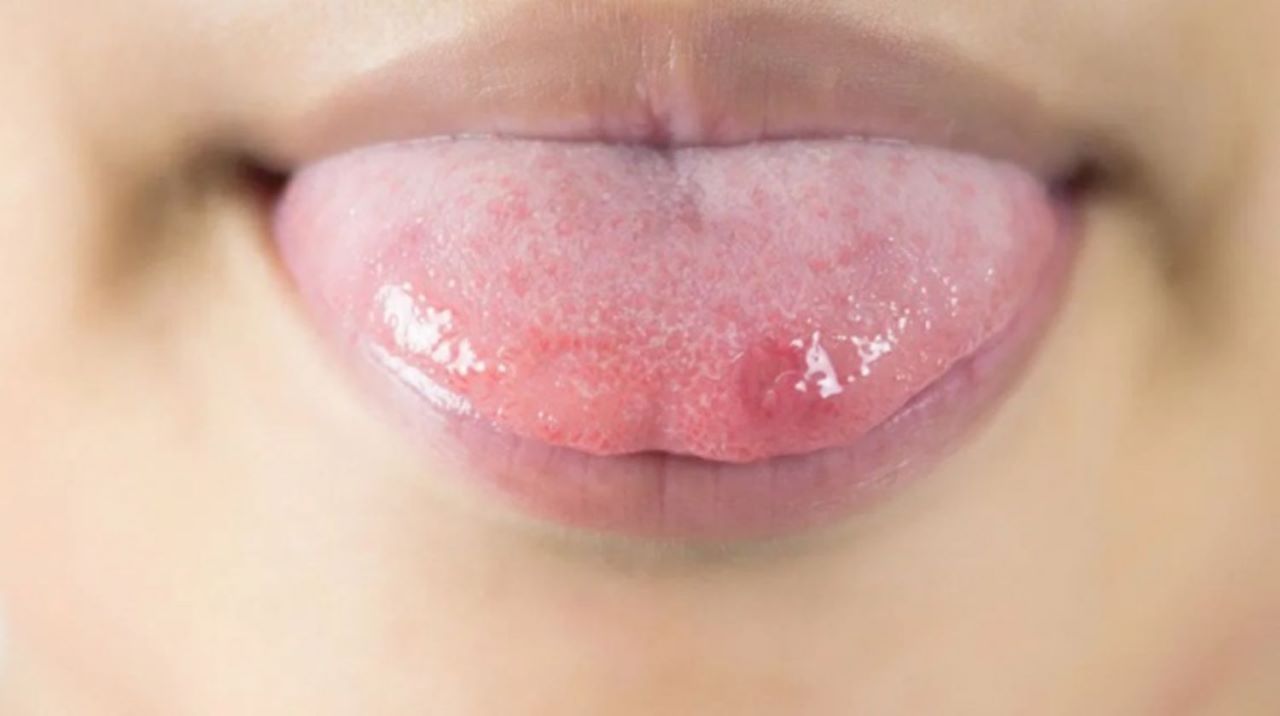 Tìm hiểu Bệnh Herpes miệng - Nỗi ám ảnh đeo bám cuộc sống 8 benh herpes o luoi 0