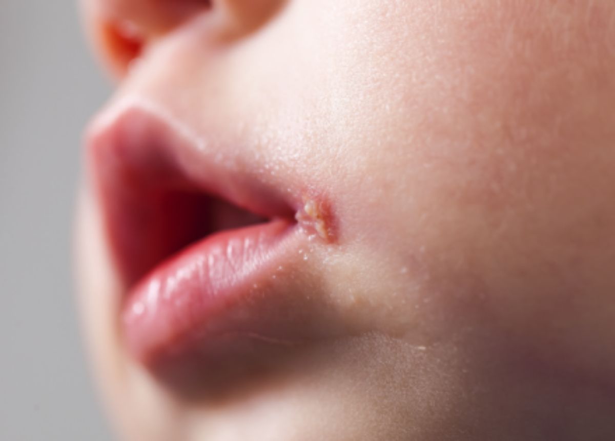 benh herpes o tre so sinh1