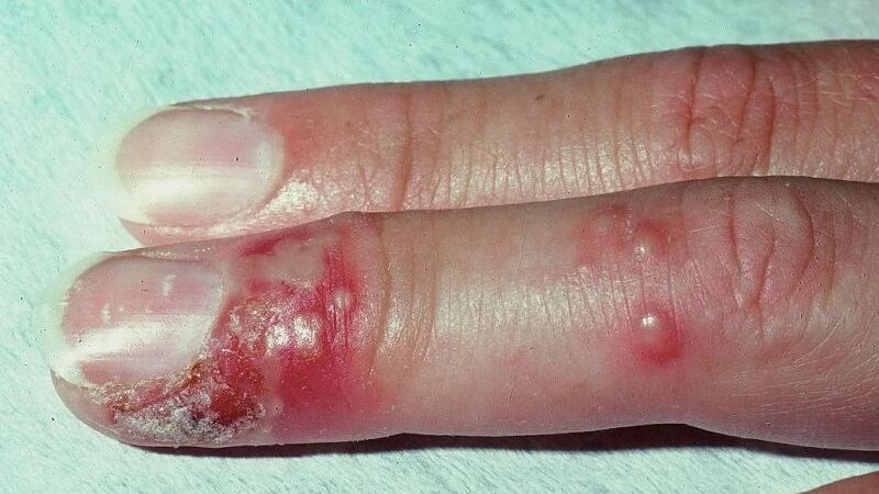 benh herpes sinh duc nguyen nhan dau hieu va bien 8 800x450 1