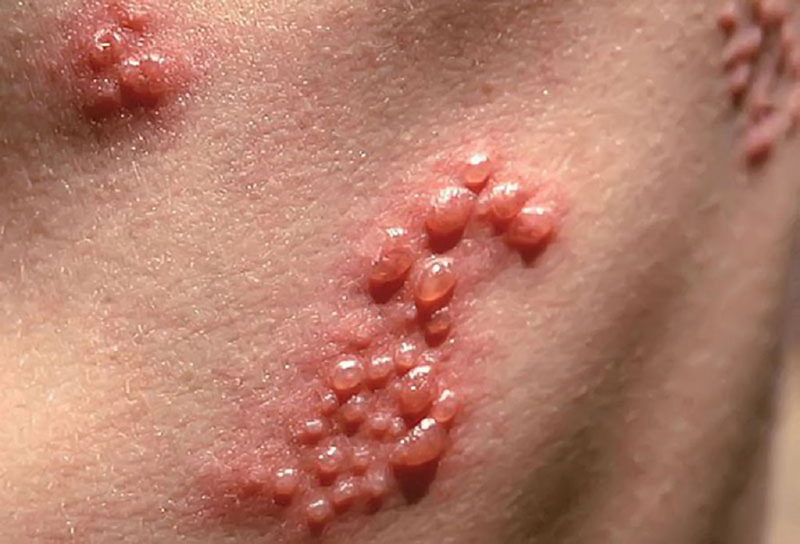 benh herpes co chua khoi duoc khong va chua bang cach nao 2 d696bfa131