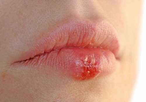 bi herpes o moi khi mang thai 1 500x350 1