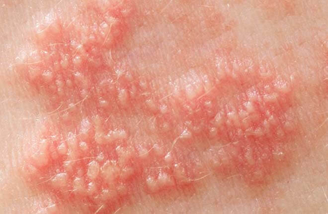 herpes sinh duc 16531897367831112707691