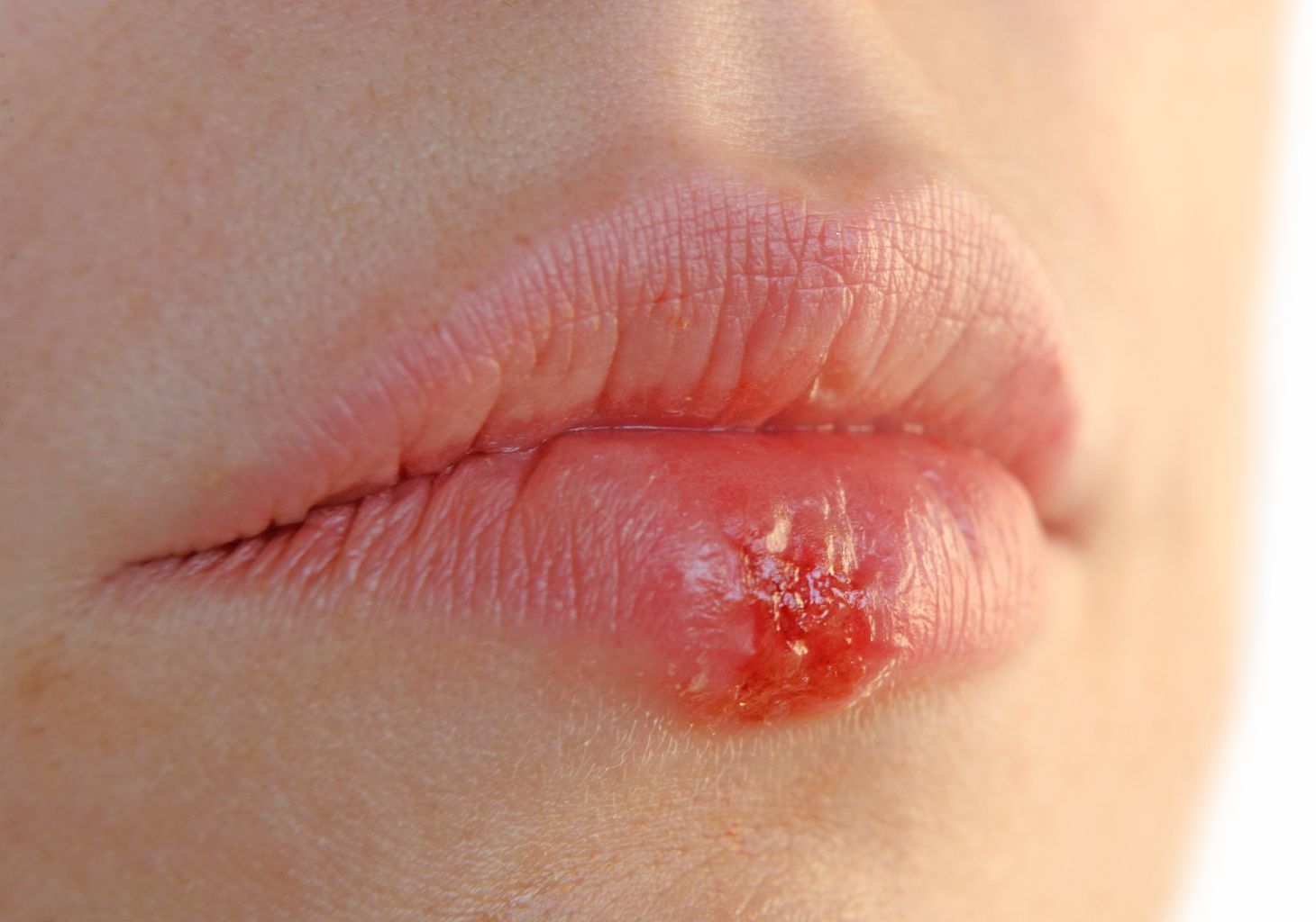 Tìm hiểu Bệnh Herpes miệng - Nỗi ám ảnh đeo bám cuộc sống 6 herpes va dung thuoc