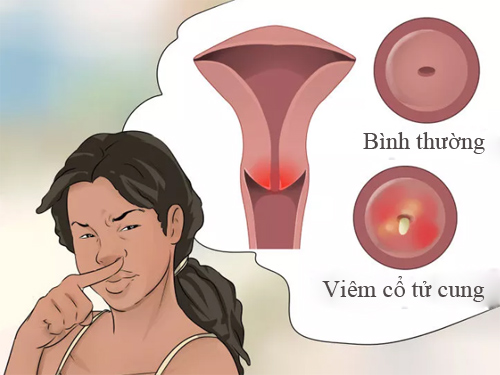 Tại sao vùng kín có mùi hôi? Dấu hiệu của bệnh gì? Cách khắc phục 6 vung kin co mui hoi va nhung dieu chi em can dac biet luu y vungkincomuihoi9 1468924076 width500height375 15949788716381163808097 1595058409390 1595058409715782891183