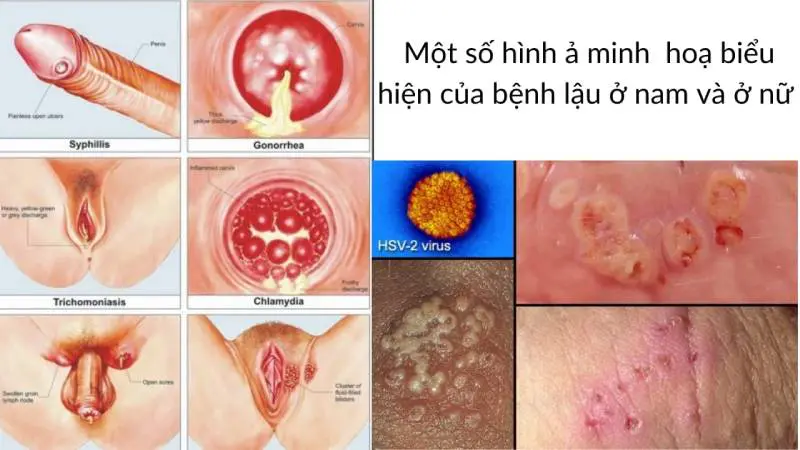 hinh anh minh hoa benh lau o nam va nu