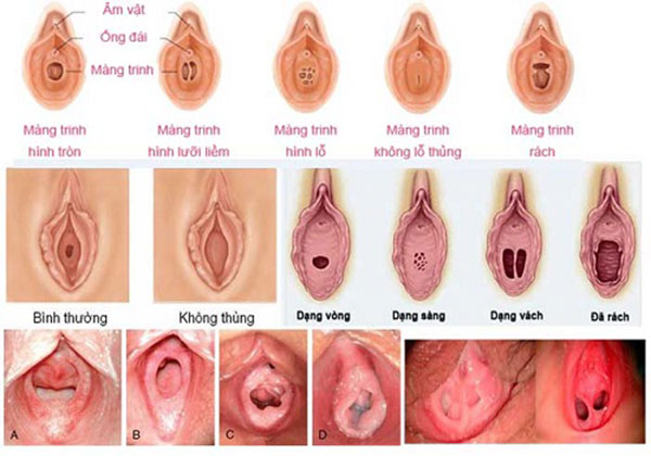 Các loại màng trinh và hình dạng màng trinh của phái nữ 5 66c987fd4bae6ab8fe056222 5dc146e6dd0bd402def624a2 cac dang mang trinh o nu gioi