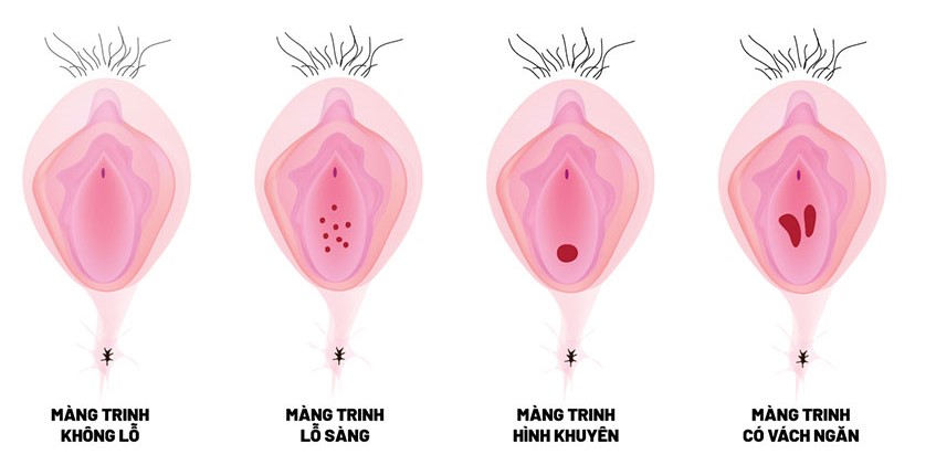 Tìm hiểu về tình trạng màng trinh dày là như thế nào 5 cac hinh dang cua mang trinh 1