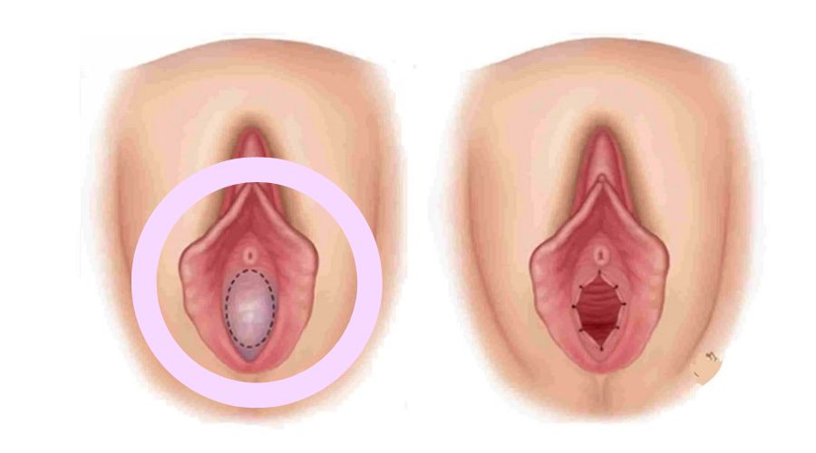 Tìm hiểu về tình trạng màng trinh dày là như thế nào 6 rach mang trinh