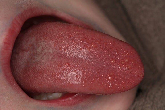 Sùi mào gà ở lưỡi có triệu chứng gì? Cách chữa trị và phòng ngừa 6