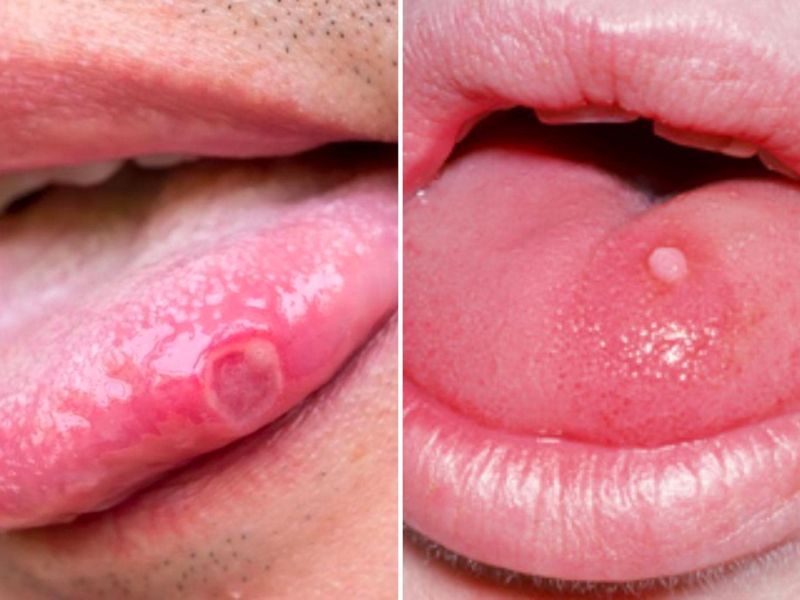 Sùi mào gà ở lưỡi có triệu chứng gì? Cách chữa trị và phòng ngừa 5 20230509 sui mao ga o luoi 1