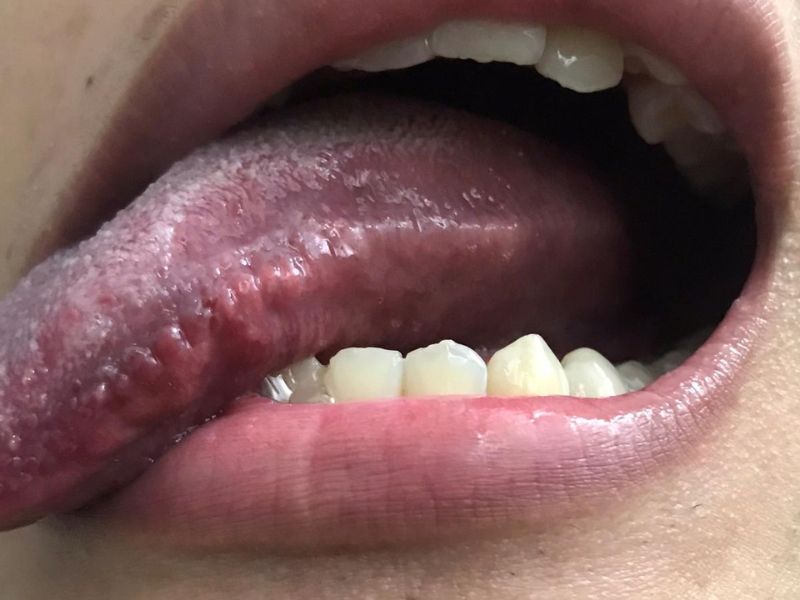 Sùi mào gà ở lưỡi có triệu chứng gì? Cách chữa trị và phòng ngừa 7 20230612 chua sui mao ga o luoi 3