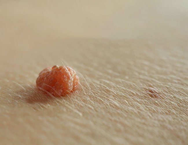 Bệnh mụn cóc sinh dục ở nam là gì? Bạn nam nên xem để phòng tránh 6