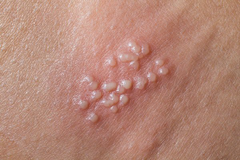 Mụn cóc sinh dục có tự khỏi hay không? Có chữa được không? 8 20201221 mun coc sinh duc nam 2