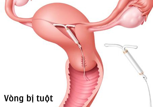 Tại sao lại bị tuột vòng tránh thai? Có nguy hiểm không? 7 60a322798ee5b941004f2457 3