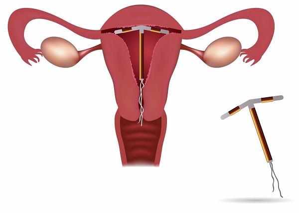 Tại sao lại bị tuột vòng tránh thai? Có nguy hiểm không? 6 dat vong tranh thai 1