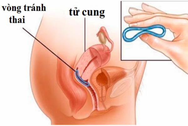 Tại sao lại bị tuột vòng tránh thai? Có nguy hiểm không? 8 thao vong tranh thai1