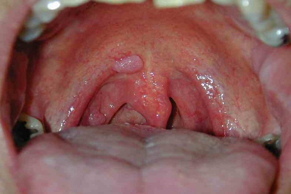 Sùi mào gà ở miệng: Biến chứng, dấu hiệu và cách điều trị 8 sui mao ga trong mieng