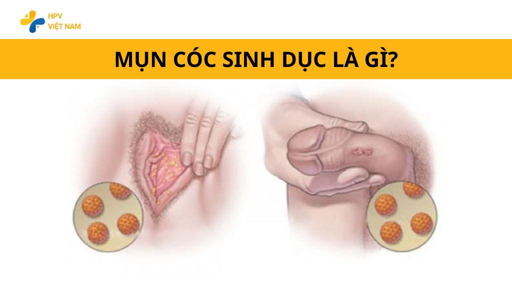 Mụn cóc sinh dục ở nữ có nguy hiểm không và biến chứng là gì? 5 J4fXn0maWeq hPqoZhGdPYoY0CaWfi70wqhs9qTxPnkT7JnfS