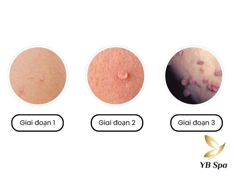 Mụn cóc sinh dục ở nữ có nguy hiểm không và biến chứng là gì? 8 TXnVF213vCNE15x7 Yw7uOppDx4L8bwRJTLoo7HnZORKkIb3UE9BSJhR DNYr4TBH2W9ITFhyxdTBABwLs8SiQHZOCQTWozeyi5RmomiEO4J9ykR5UlMX4g6WLkU6h5ZOhTA5Oa85YQgfhao2LH xwBszQAF3syYQ29HJDZg D8Ntaq6n43JABV5Q41ZZjUY
