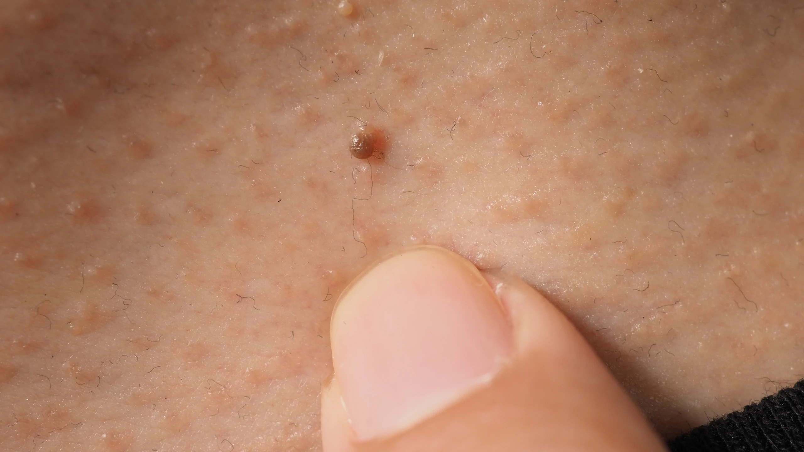 Những lưu ý về mụn cóc sinh dục khi mang thai bạn cần biết 6 mun coc sinh duc nguyen nhan phuong phap chan doan dieu tri va phong ngua 1 79dab87275