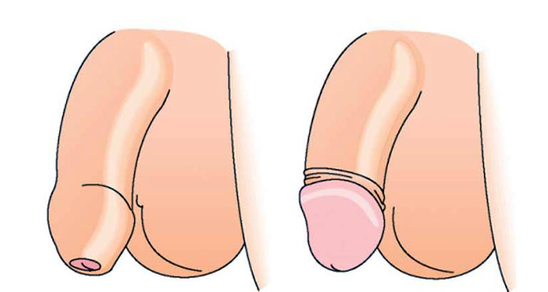 Đầu khấc dương vật là gì? Những sự thật thú vị về đầu khất 7 bao quy dau dai