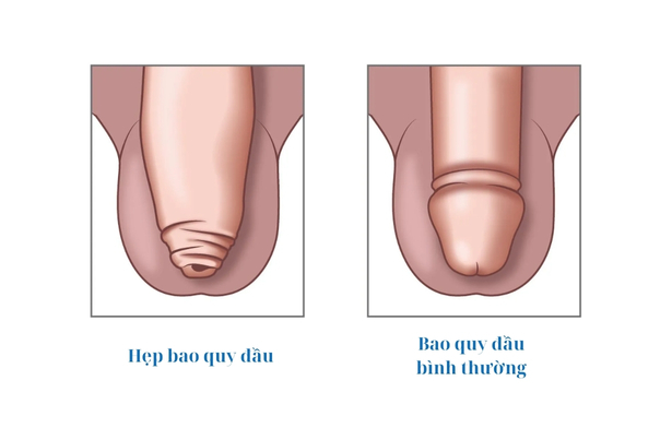 hep bao quy dau la gi