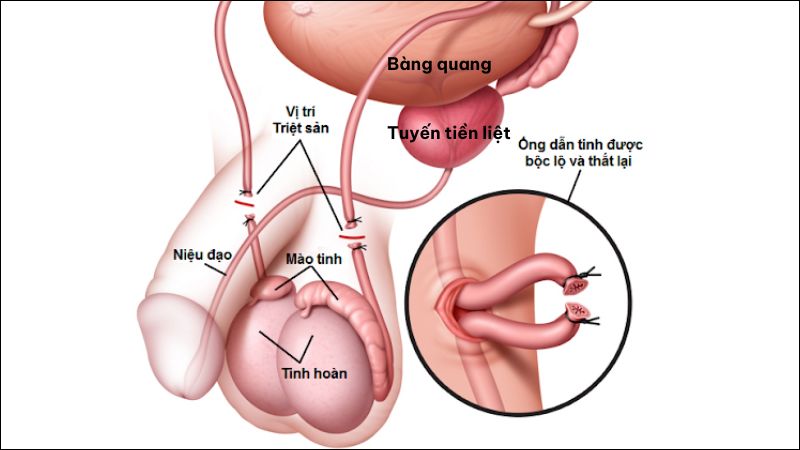 Thắt ống dẫn tinh có ảnh hưởng đến sinh lý không? Xuất tinh được không 7 that ong dan tinh co anh huong gi khong luu y khi quan he tinh duc 1