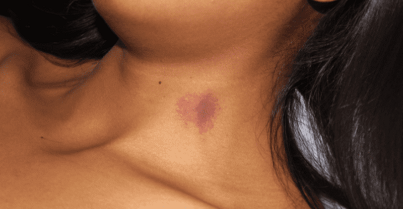 giai dap hickey la gi
