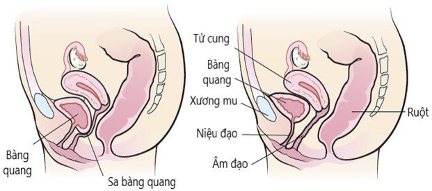 giai phau bang quang