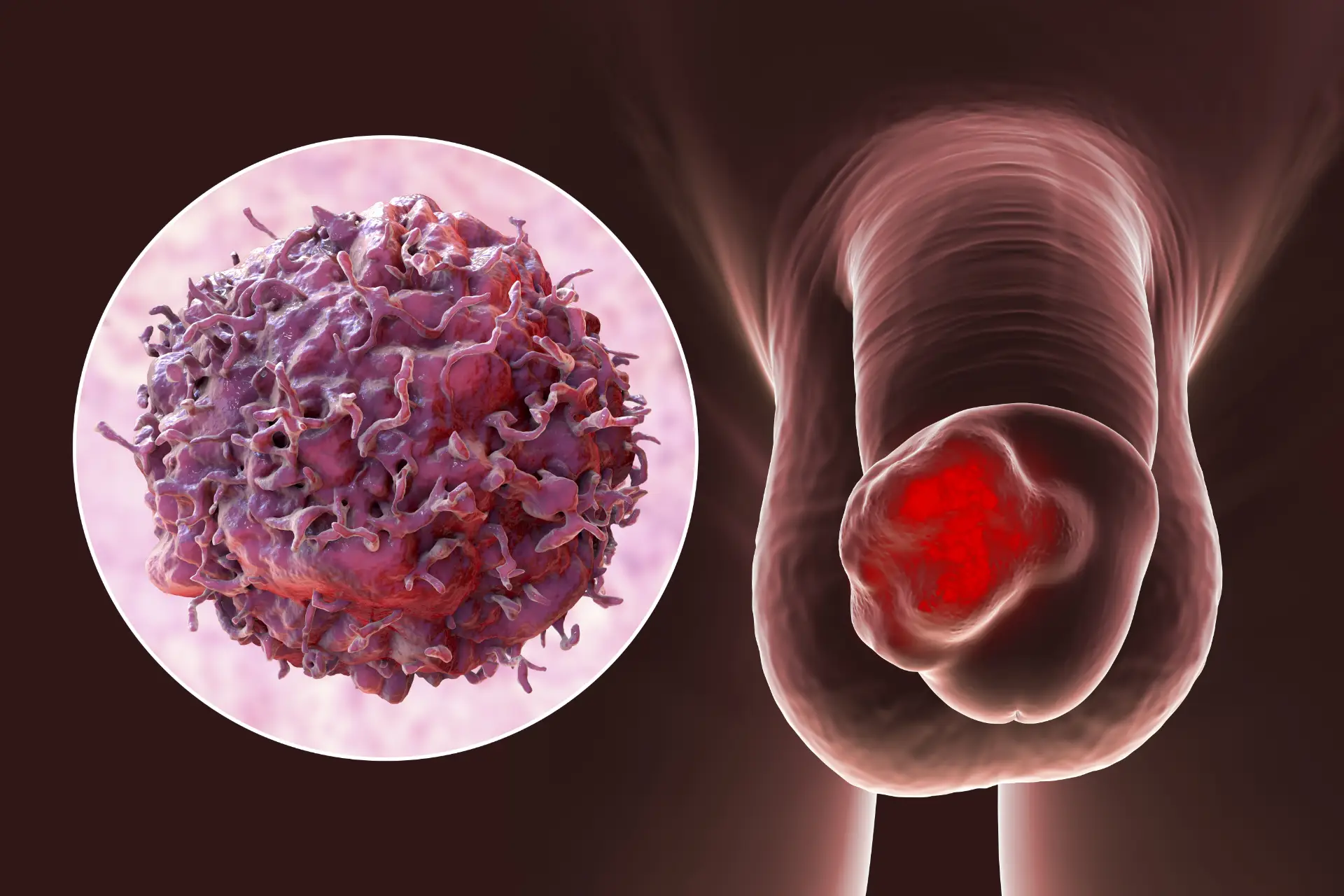 penile cancer treatment singapore