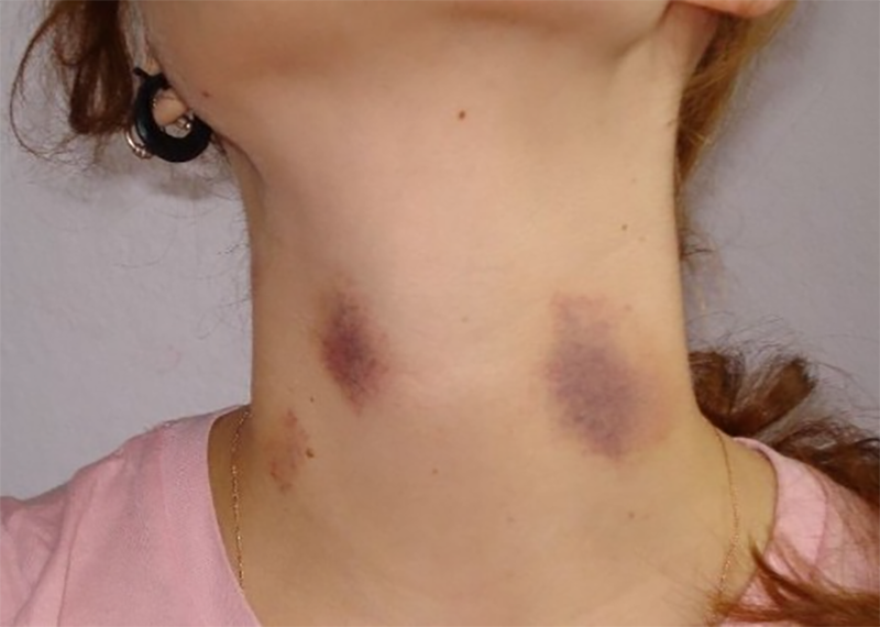 tat tan tat ve dau hickey 9 f9f8154185