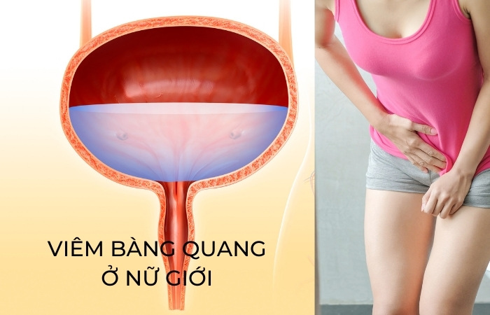 viem bang quang o nu gioi