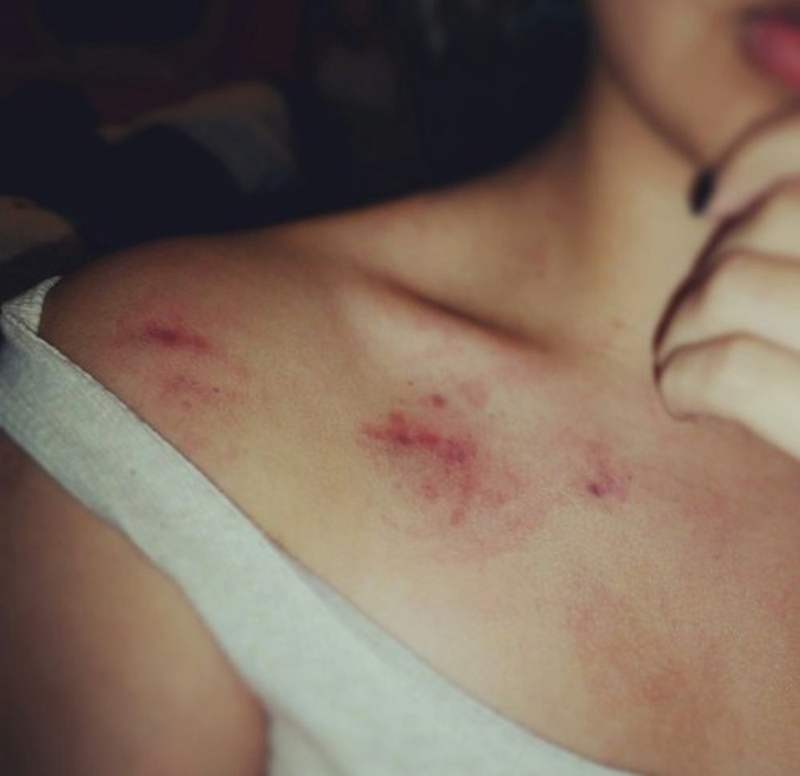 dau hickey la gi hickey co nguy hiem khong 22ba84df50