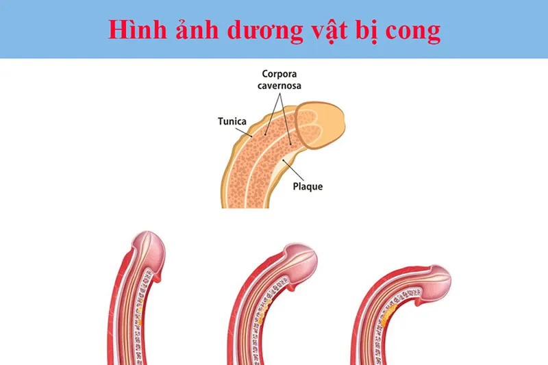duong vat bi cong