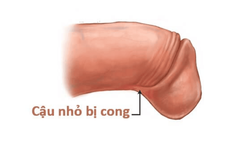 duong vat cong xuong la hien tuong gi
